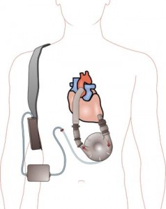 340px-Ventricular_assist_device-238x300