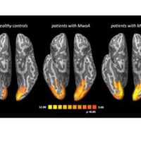 'Fotografato' il cervello col mal di testa