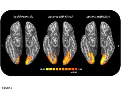 ‘Fotografato’ il cervello col mal di testa