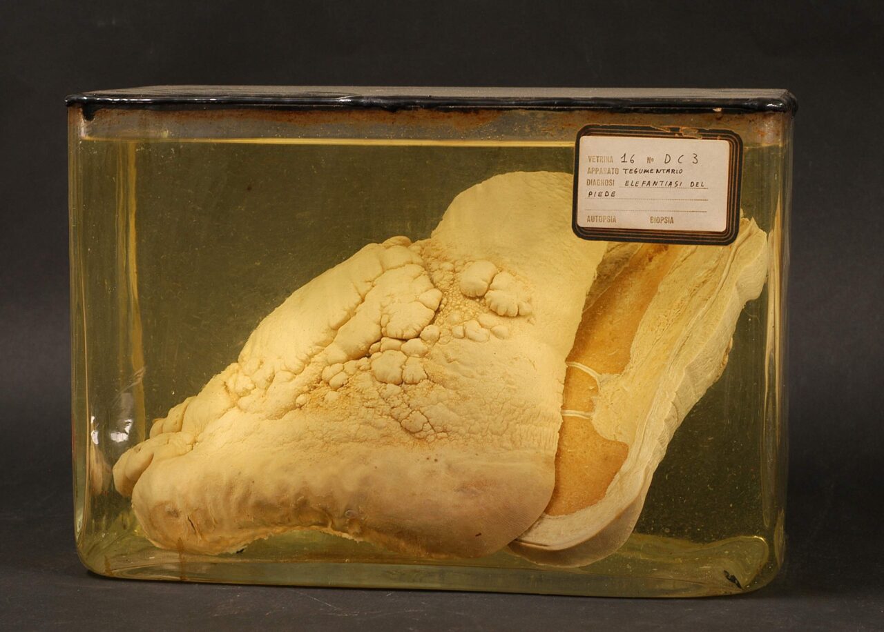 Elefantiasi del piede. Foto tratta dal sito Museo di storia della medicina (http://reperti.musme.padova.it/Reperti.aspx)