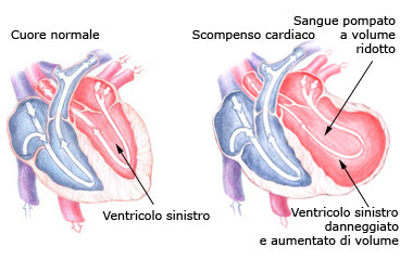 scompenso-cardiaco-cure