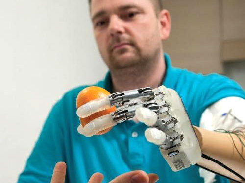 Prima mondiale: il dito bionico ridona il tatto