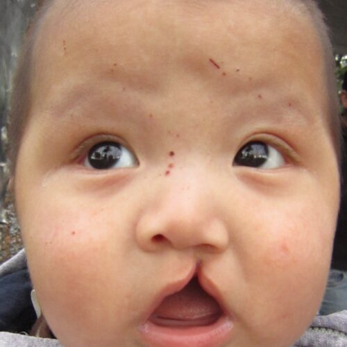 Ogni anno nascono 165mila bambini con il labbro leporino