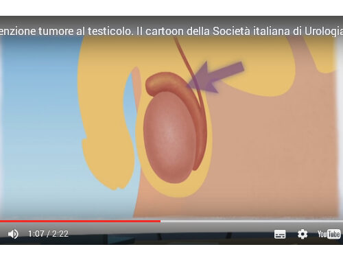 Cancro al testicolo: è il più frequente in età giovanile