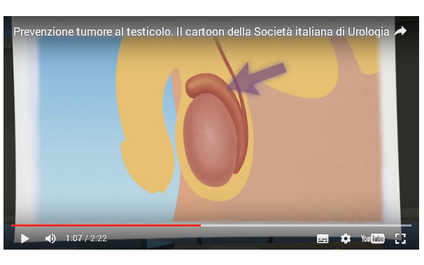 Cancro al testicolo: è il più frequente in età giovanile