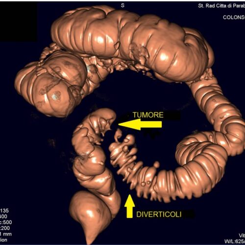 Colonscopia virtuale: innovazione e prevenzione