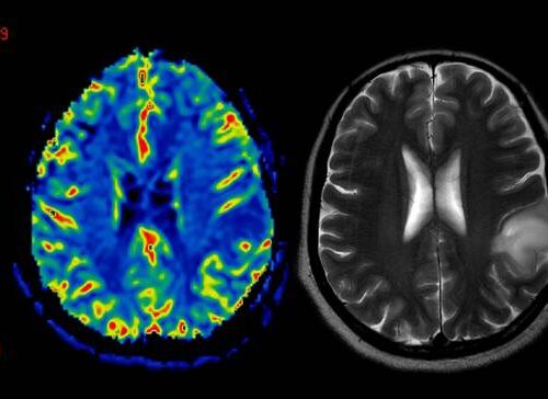 L’aspirina “liquida” contro il cancro al cervello