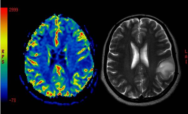 L’aspirina “liquida” contro il cancro al cervello