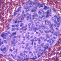 Cellule "kamikaze" contro i tumori del sangue. Nuova speranza di cure