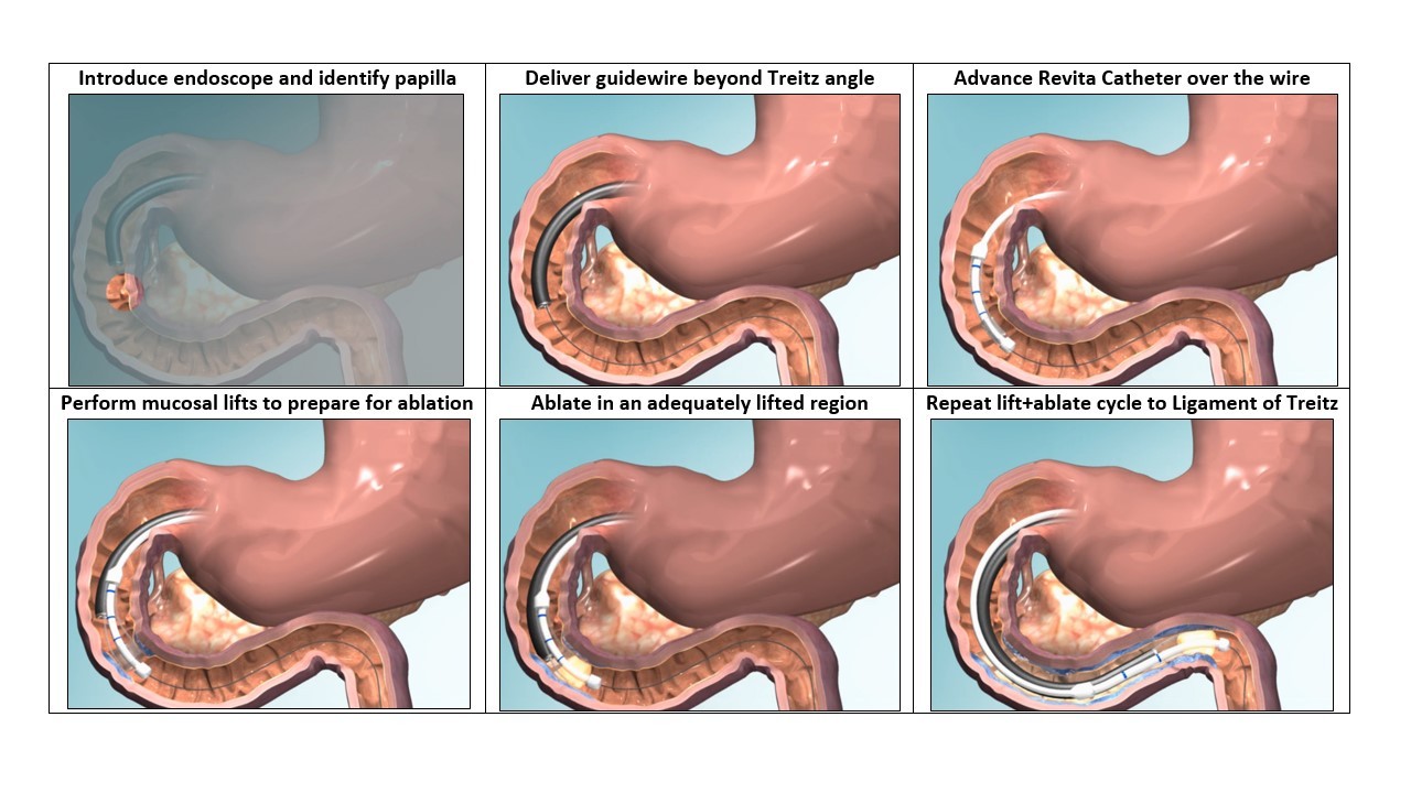 diabeteprocedure