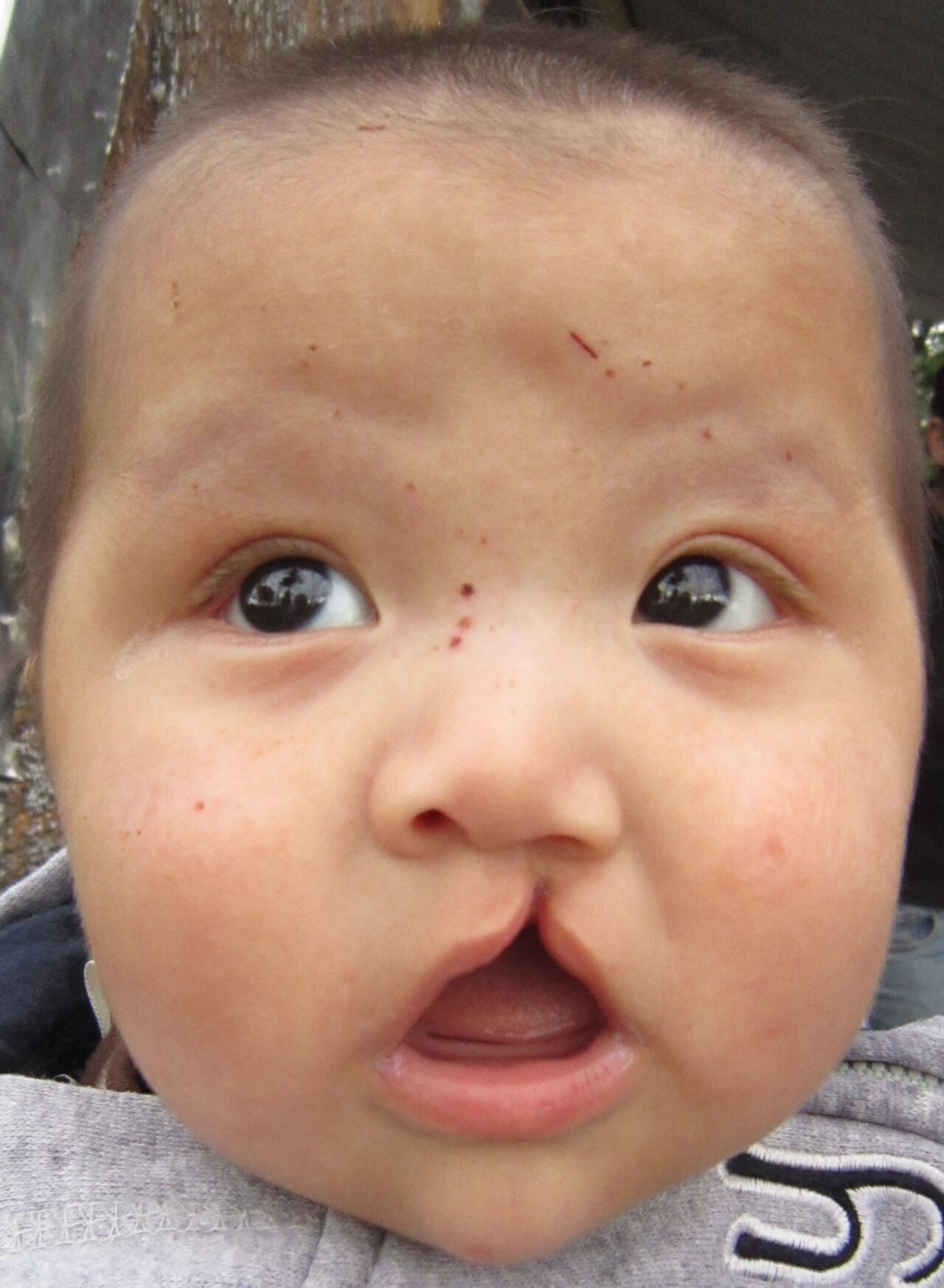 ”Labbro leporino”. Ogni 3 minuti, nel mondo, nasce un bambino con labiopalatoschisi