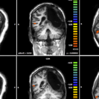 Ictus dopo incidente. Il cervello si salva spostando «centraline cognitive» dall’emisfero sinistro al destro