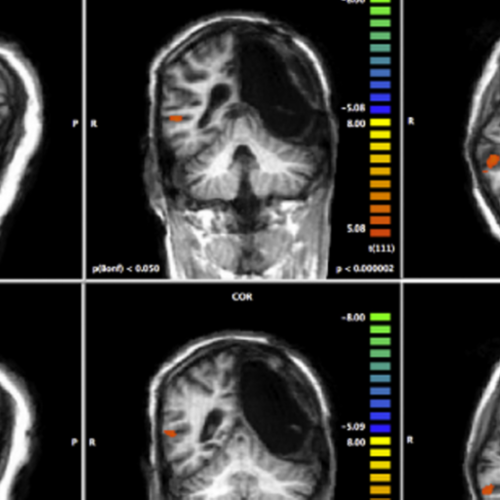 Ictus dopo incidente. Il cervello si salva spostando «centraline cognitive» dall’emisfero sinistro al destro