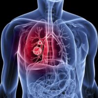 CNR: dimostrato ruolo chiave oncogene BM1 nel tumore del polmone