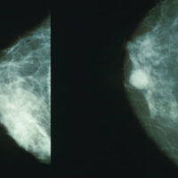 Mammografie: ogni 3 anni o annuali. Un nuovo studio stabilisce quando effettuare lo screening