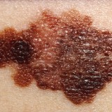 Melanoma