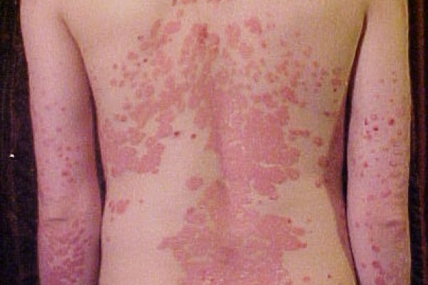 Di User:The Wednesday Island (of the English Wikipedia) - http://en.wikipedia.org/wiki/Image:Psoriasis_on_back.jpg, CC BY-SA 3.0, https://commons.wikimedia.org/w/index.php?curid=1084344