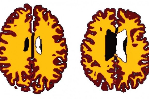 Comparison of grey matter (brown) and white matter (yellow) in sex-matched subjects A (56 years, BMI 19.5) and B (50 years, BMI 43.4). Credit: Lisa Ronan