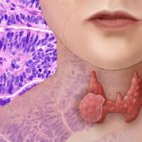 Tumori della tiroide, in Italia 40mila interventi di rimozione totale. Troppi?