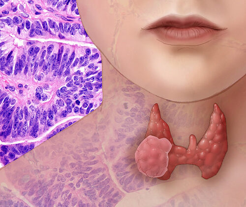 Tumori della tiroide, in Italia 40mila interventi di rimozione totale. Troppi?