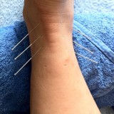 acupuncture-1211182_640