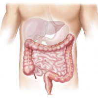 Nuovo trattamento per le fistole dovute al Crohn