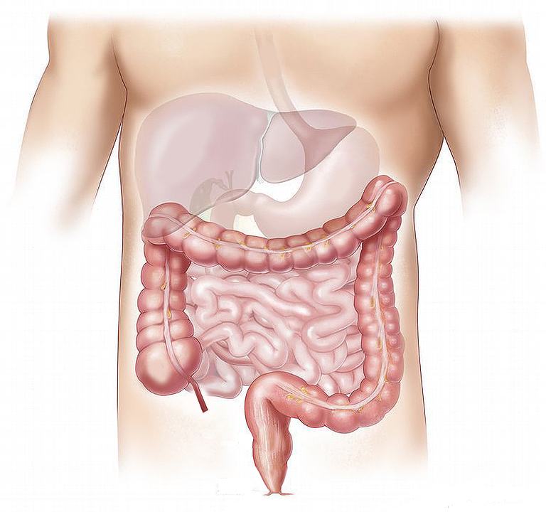 Nuovo trattamento per le fistole dovute al Crohn