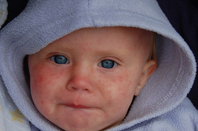 Il morbillo può dare più complicanze del previsto. Nuovo studio