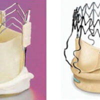 Valvole sutureless, il futuro della cardiochirurgia