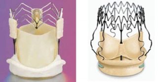 https://www.policlinicodimonza.it/nichel-titanio-le-protesi-valvolari-dell%E2%80%99aorta