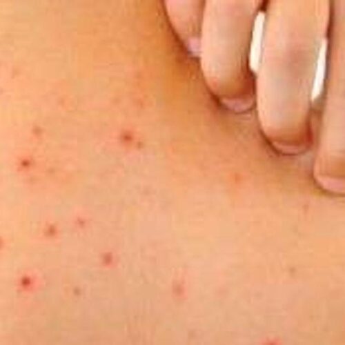 Varicella, fate molta attenzione alle complicanze