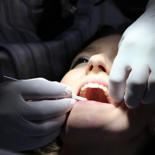 Detartrage dei denti almeno ogni 6 mesi per non rischiare gengiviti