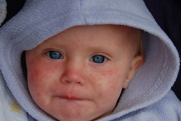 Morbillo, non si scherza. Metà dei casi finisce in ospedale