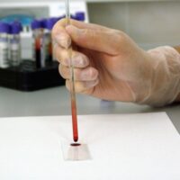 Lila onlus: Record di accessi ai test rapidi Hiv, oltre 700 in 15 giorni