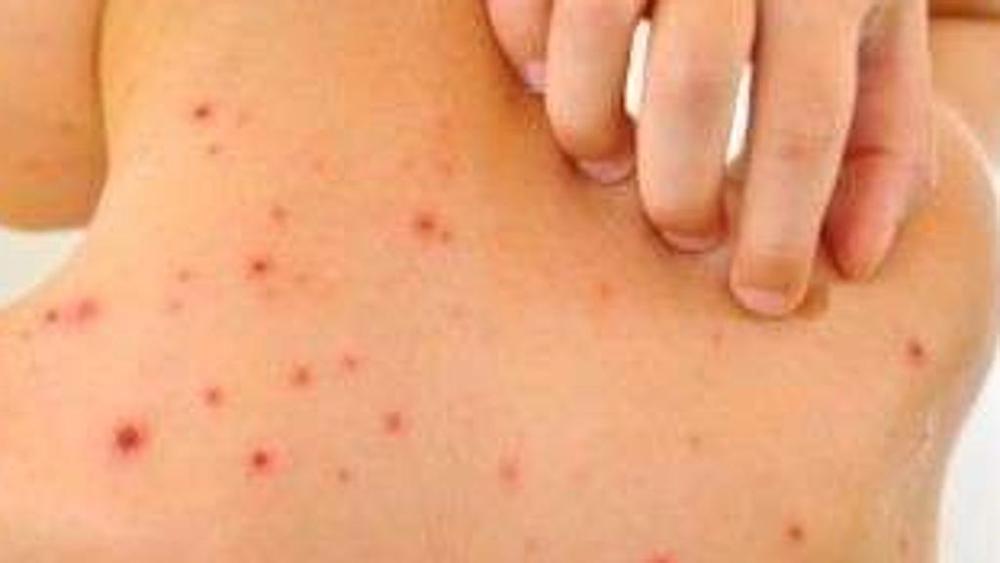 Varicella, fate molta attenzione alle complicanze