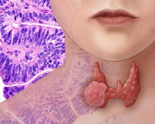 Tumore tiroide, 11% dei pazienti ha diagnosi in solitudine