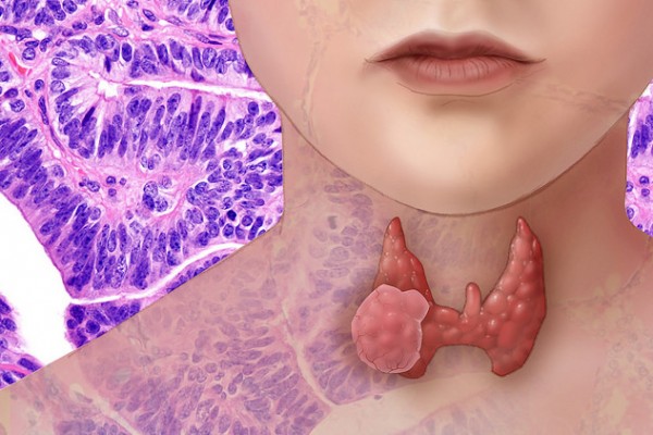 Tumore tiroide, 11% dei pazienti ha diagnosi in solitudine