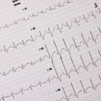 In pronto soccorso nuove tecniche per la diagnosi dell'infarto