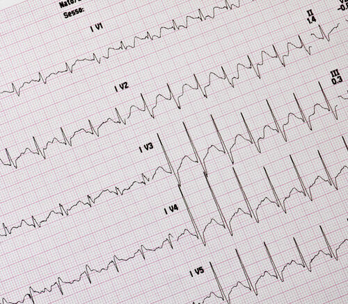 In pronto soccorso nuove tecniche per la diagnosi dell’infarto