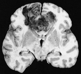 Glioblastoma non trattato. Esame macroscopico Di The Armed Forces Institute of Pathology (AFIP) 