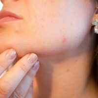 Arriva in Italia nuova tecnologia per la cura dell'acne