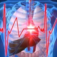 Infarti e ictus, con la prevenzione si evitano sempre di più ma aumentano i malati cronici