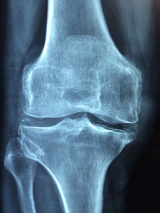 Sanità, Sirn: “Scoperto legame tra sclerosi multipla e osteoporosi”