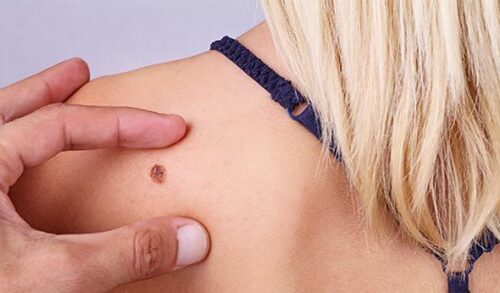 Le diagnosi di melanoma raddoppiate in dieci anni: sono 14mila