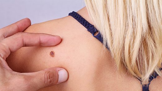 Le diagnosi di melanoma raddoppiate in dieci anni: sono 14mila
