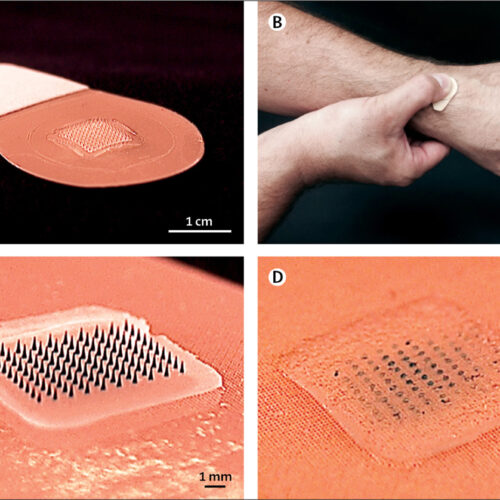 Un cerotto al posto dell’iniezione per vaccinarsi contro l’influenza