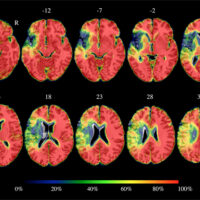 Riabilitazione, stimolare il midollo spinale per migliorare linguaggio