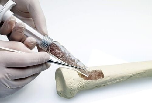 Ecco il vetro bioattivo che cura le infiammazioni da protesi. Lo studio Unimore