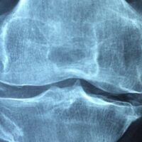 Osteoporosi, il 75% delle donne over 60 va incontro a frattura