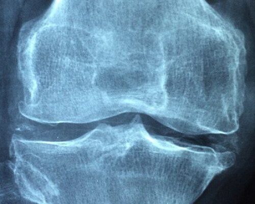 Osteoporosi, il 75% delle donne over 60 va incontro a frattura